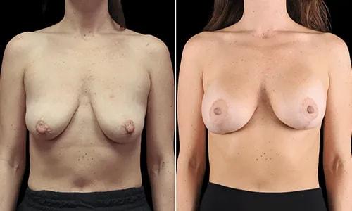 Breast Lift result at Joyce Aycock, MD in Denver, CO