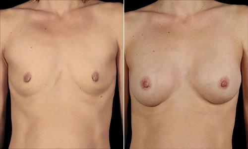 Joyce Aycock, MD breast augmentation result — Denver, CO