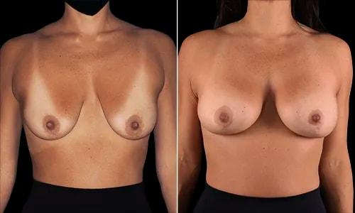Breast Lift result at Joyce Aycock, MD in Denver, CO