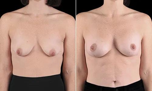 Breast Lift result at Joyce Aycock, MD in Denver, CO
