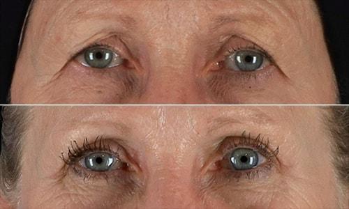 Joyce Aycock, MD eyelid lift result — Denver, CO