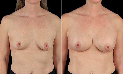 Joyce Aycock, MD breast augmentation result — Denver, CO