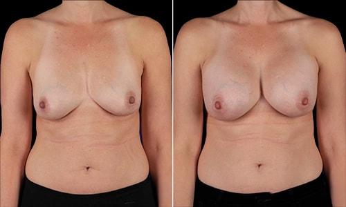 Joyce Aycock, MD breast augmentation result — Denver, CO