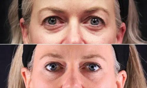 Joyce Aycock, MD eyelid lift result — Denver, CO