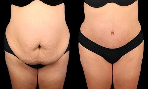 Tummy Tuck result at Joyce Aycock, MD in Denver, CO