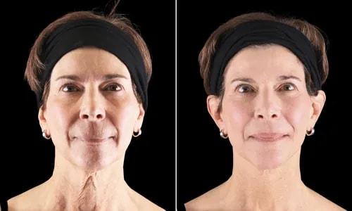 Neck Lift result at Joyce Aycock, MD in Denver, CO