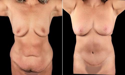 Mommy Makeover result at Joyce Aycock, MD in Denver, CO
