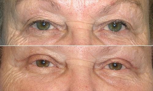 Joyce Aycock, MD eyelid lift result — Denver, CO
