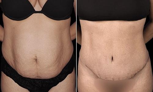 Tummy Tuck result at Joyce Aycock, MD in Denver, CO