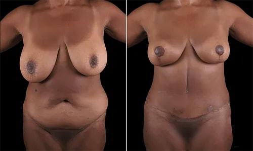 Mommy Makeover result at Joyce Aycock, MD in Denver, CO