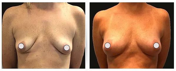 Dr. Binh Nguyen, MD, Board Certified Plastic Surgeon result — Cincinnati, OH