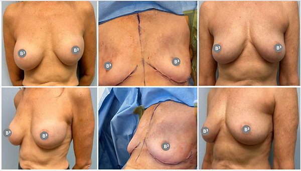 Dr. Binh Nguyen, MD, Board Certified Plastic Surgeon result — Cincinnati, OH