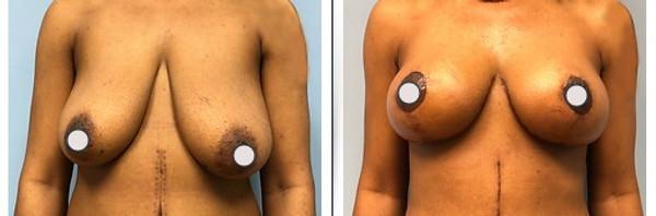 Breast Lift result at Dr. Binh Nguyen, MD, Board Certified Plastic Surgeon in Cincinnati, OH