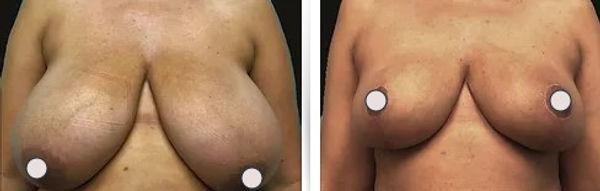 Breast Reduction result at Dr. Binh Nguyen, MD, Board Certified Plastic Surgeon in Cincinnati, OH