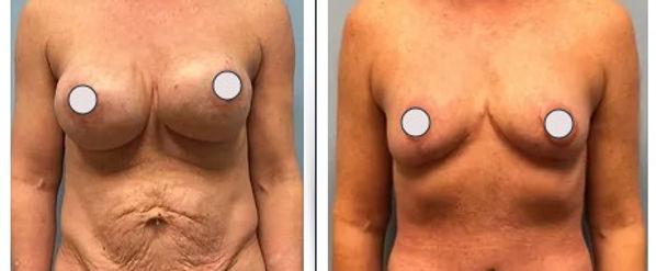 Dr. Binh Nguyen, MD, Board Certified Plastic Surgeon result — Cincinnati, OH
