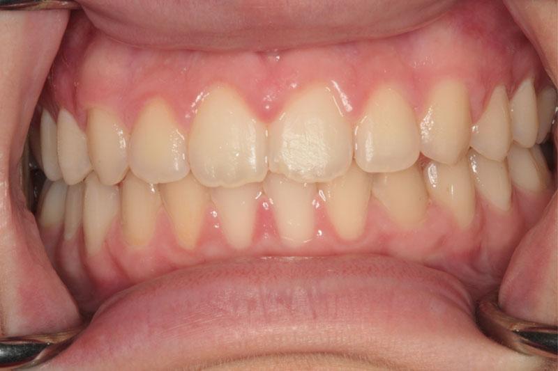 Harder Dental: Drs. Harder, Pham & Associates invisalign after — Irvine, CA