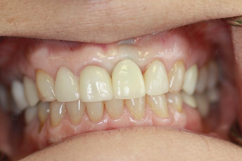 Harder Dental: Drs. Harder, Pham & Associates dental crowns after — Irvine, CA
