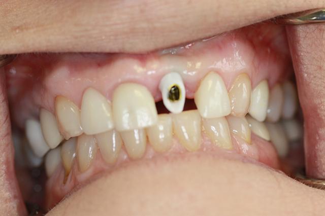 Dental Crowns before at Harder Dental: Drs. Harder, Pham & Associates in Irvine, CA