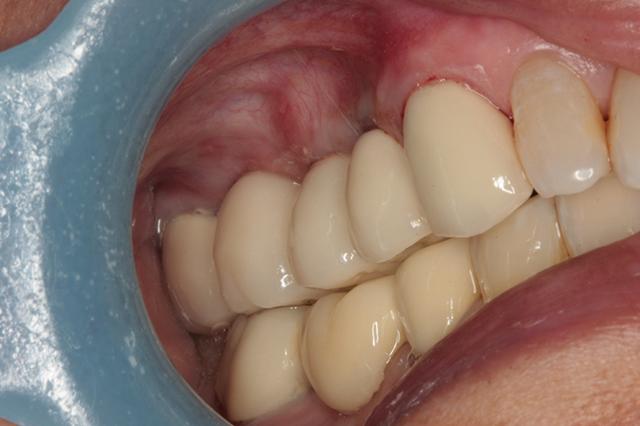 Dental Crowns after at Harder Dental: Drs. Harder, Pham & Associates in Irvine, CA