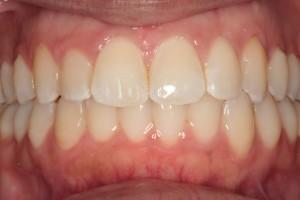 Harder Dental: Drs. Harder, Pham & Associates invisalign after — Irvine, CA