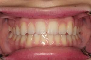 Harder Dental: Drs. Harder, Pham & Associates invisalign after — Irvine, CA