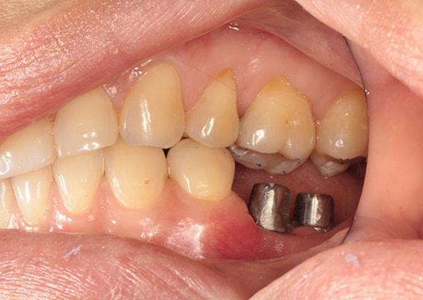 Dental Implants before at Harder Dental: Drs. Harder, Pham & Associates in Irvine, CA