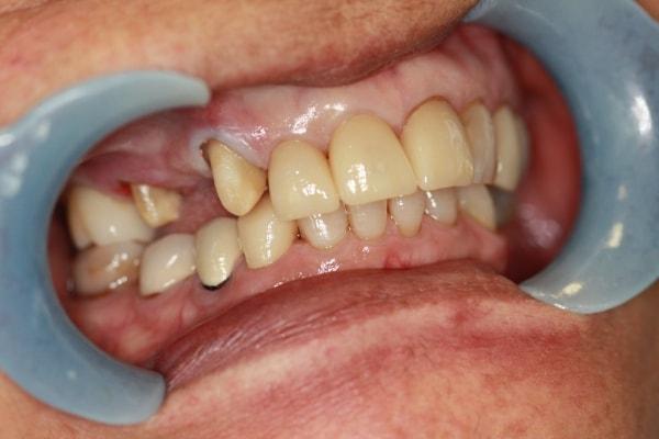 Dental Crowns before at Harder Dental: Drs. Harder, Pham & Associates in Irvine, CA