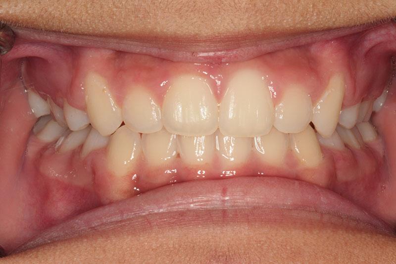 Harder Dental: Drs. Harder, Pham & Associates invisalign after — Irvine, CA