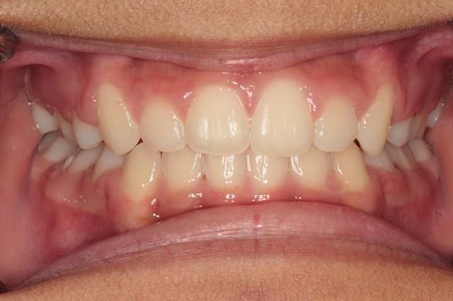 Invisalign after at Harder Dental: Drs. Harder, Pham & Associates in Irvine, CA