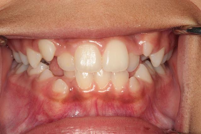 Invisalign before at Harder Dental: Drs. Harder, Pham & Associates in Irvine, CA