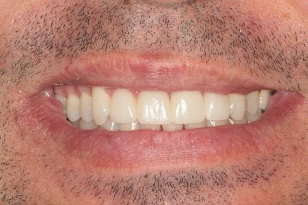 Harder Dental: Drs. Harder, Pham & Associates smile makeover after — Irvine, CA
