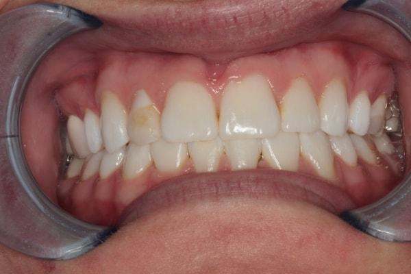 Dental Veneers before at Harder Dental: Drs. Harder, Pham & Associates in Irvine, CA