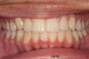 Harder Dental: Drs. Harder, Pham & Associates invisalign after — Irvine, CA