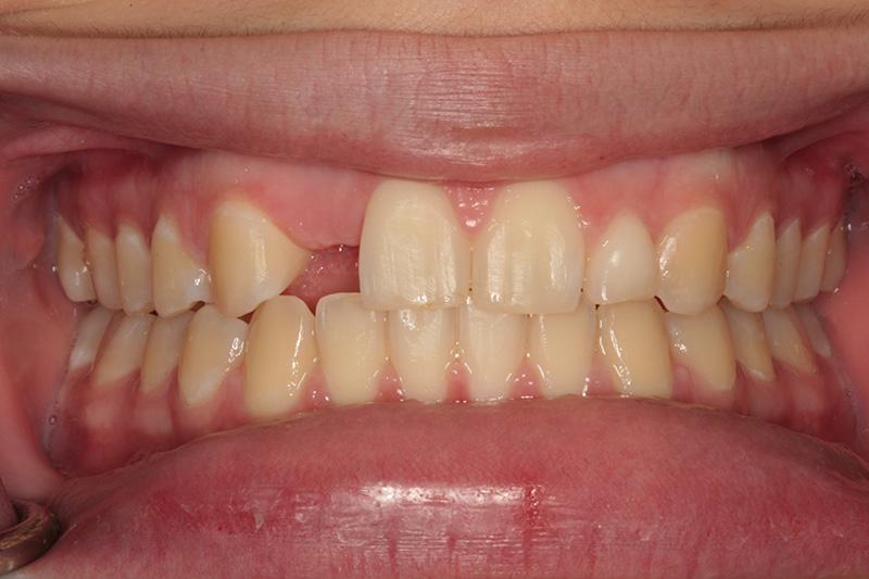 Harder Dental: Drs. Harder, Pham & Associates invisalign after — Irvine, CA