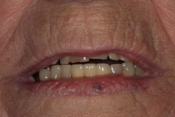Dental Crowns before at Harder Dental: Drs. Harder, Pham & Associates in Irvine, CA