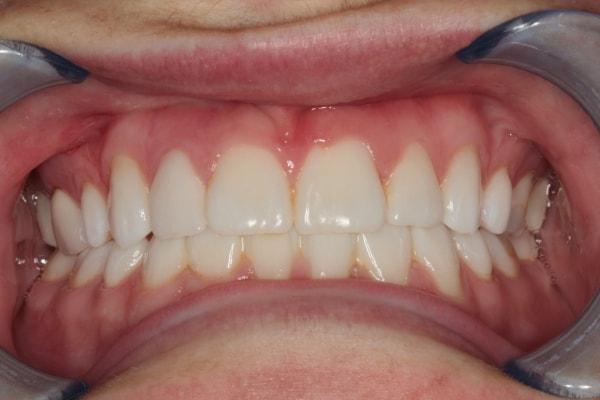 Dental Veneers after at Harder Dental: Drs. Harder, Pham & Associates in Irvine, CA