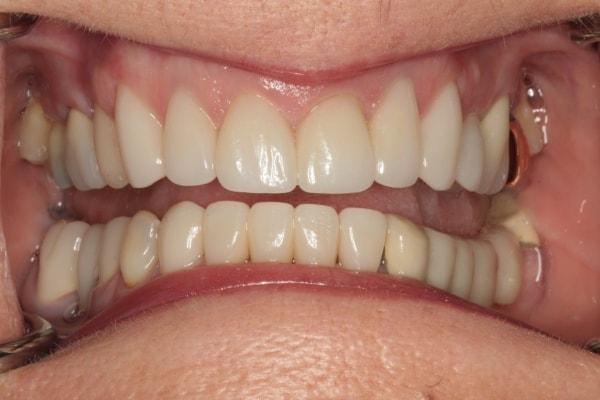 Harder Dental: Drs. Harder, Pham & Associates smile makeover after — Irvine, CA