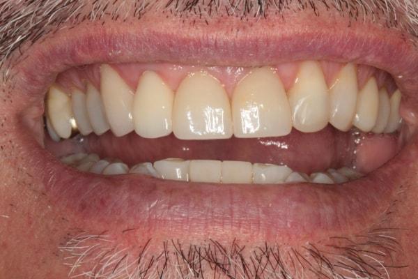 Smile Makeover after at Harder Dental: Drs. Harder, Pham & Associates in Irvine, CA