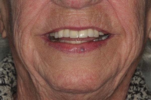Harder Dental: Drs. Harder, Pham & Associates dental crowns after — Irvine, CA