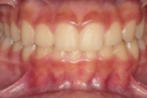 Invisalign after at Harder Dental: Drs. Harder, Pham & Associates in Irvine, CA