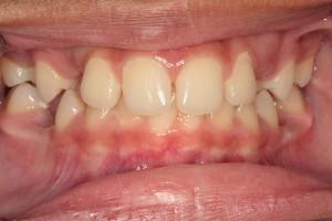 Invisalign before at Harder Dental: Drs. Harder, Pham & Associates in Irvine, CA