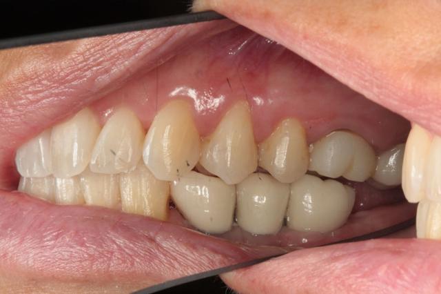 Dental Crowns after at Harder Dental: Drs. Harder, Pham & Associates in Irvine, CA