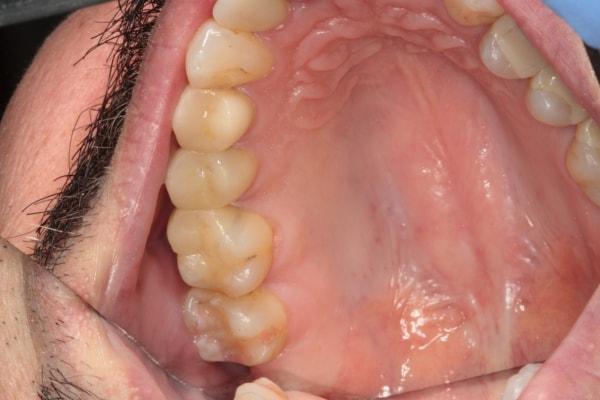 Harder Dental: Drs. Harder, Pham & Associates dental crowns after — Irvine, CA