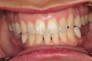 Harder Dental: Drs. Harder, Pham & Associates invisalign after — Irvine, CA