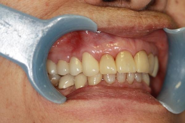 Harder Dental: Drs. Harder, Pham & Associates dental crowns after — Irvine, CA