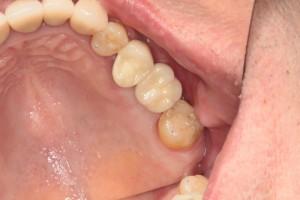 Dental Implants after at Harder Dental: Drs. Harder, Pham & Associates in Irvine, CA