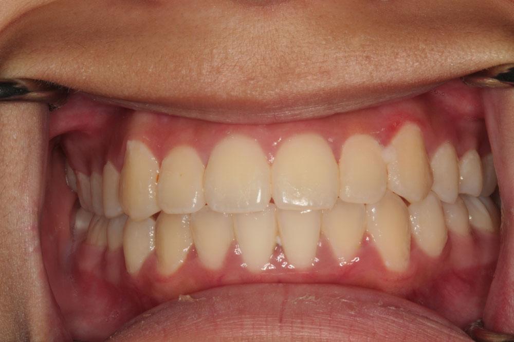 Harder Dental: Drs. Harder, Pham & Associates invisalign after — Irvine, CA