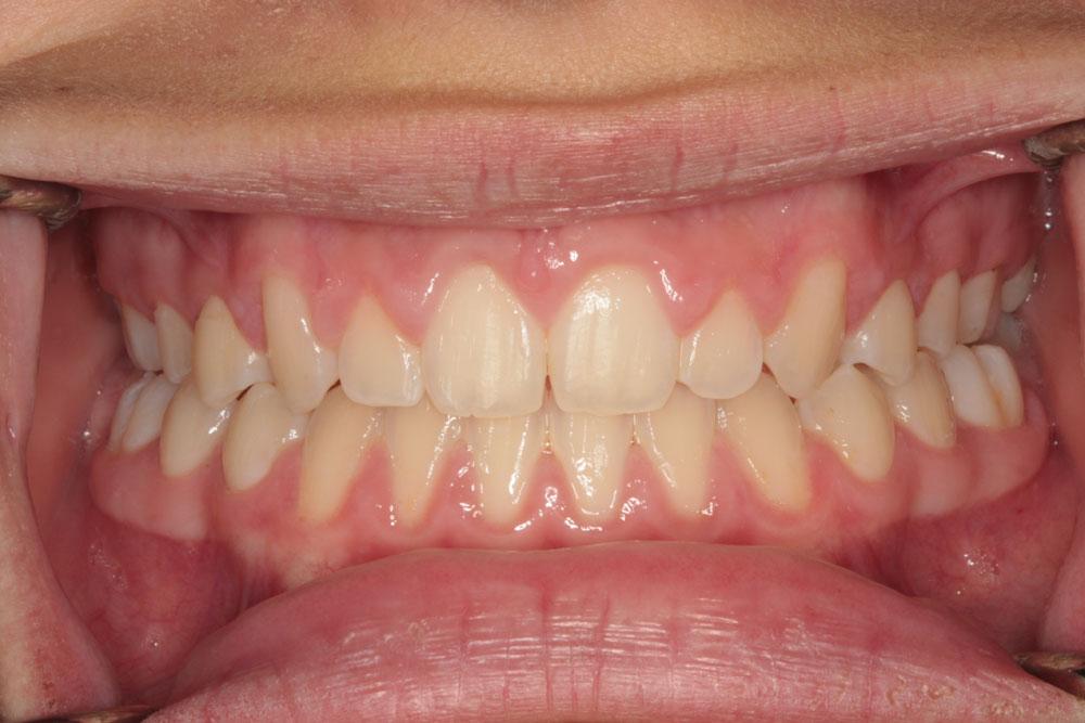 Harder Dental: Drs. Harder, Pham & Associates invisalign after — Irvine, CA