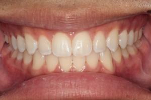 Harder Dental: Drs. Harder, Pham & Associates invisalign after — Irvine, CA