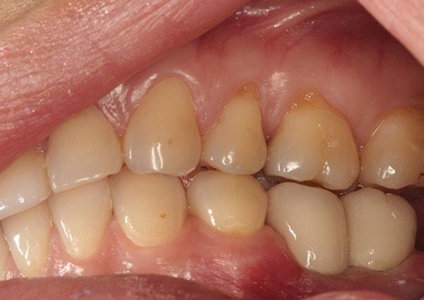 Harder Dental: Drs. Harder, Pham & Associates dental implants after — Irvine, CA